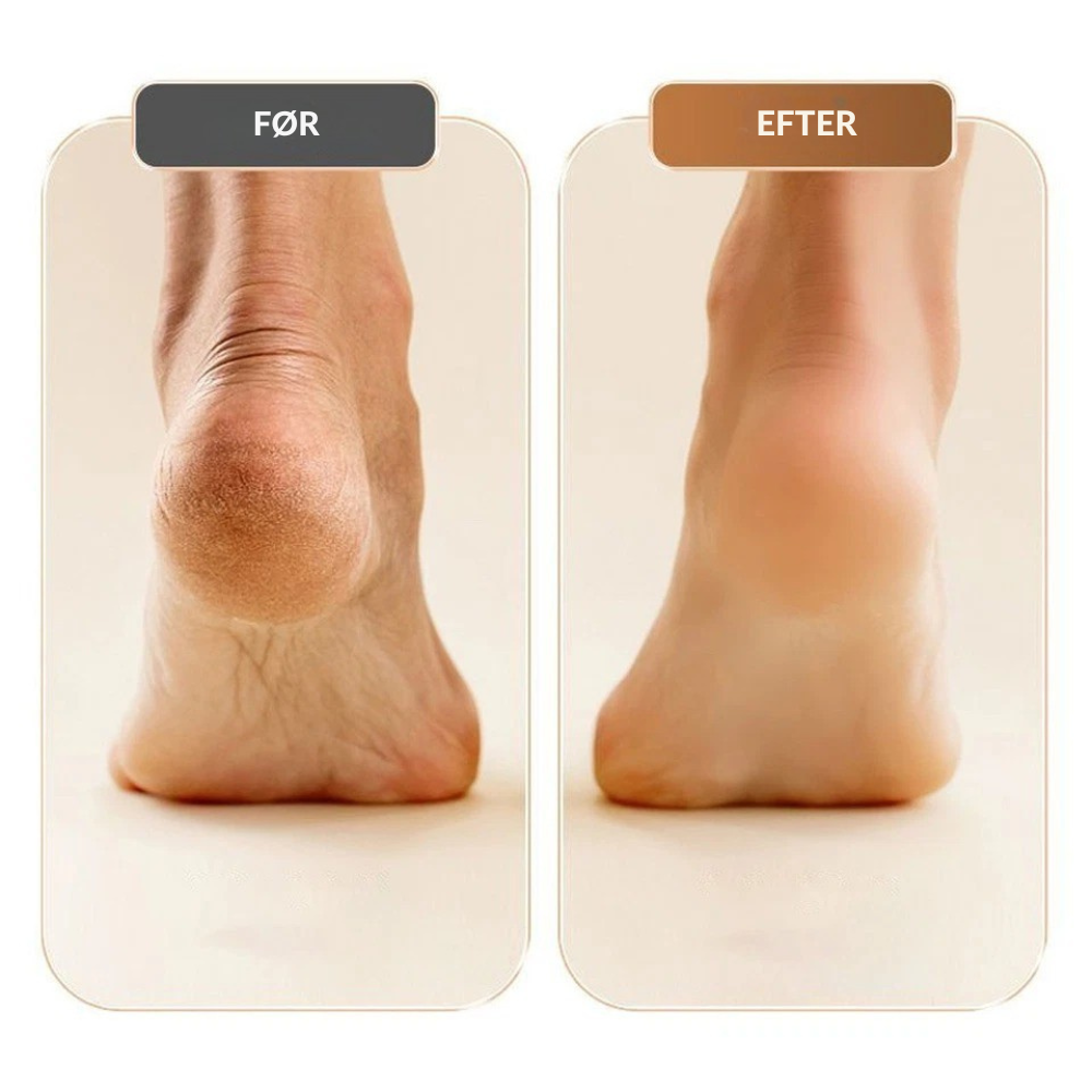 SilkSole™ | Elektrisk fjernelse af hård hud til glatte fødder