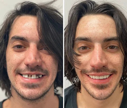 DentSecure™ | Få et stærkt, sikkert og bekymringsfrit smil hele dagen