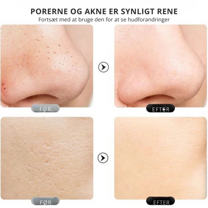 DermaPure™ | Ultralydsskrubber til huden