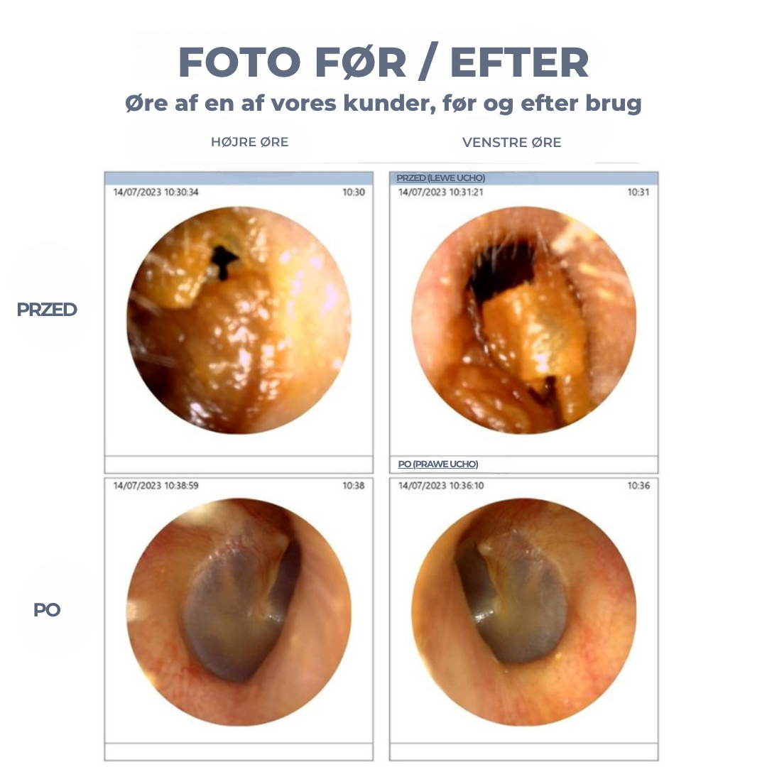 WaxClear™ | Intelligent ørerensning med avanceret teknologi