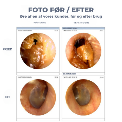 WaxClear™ | Intelligent ørerensning med avanceret teknologi