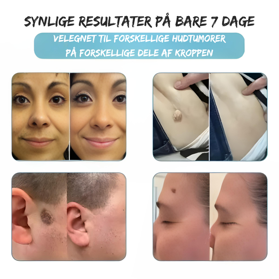 SilkLaser™ | Præcision og blødhed i ét