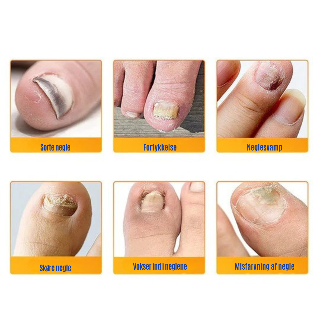 NailRepair™ | Plaster til neglesvamp