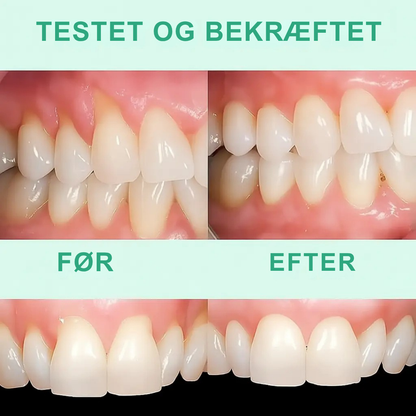 GumVital™ | Synlig bedring af tandkødet på 93%!