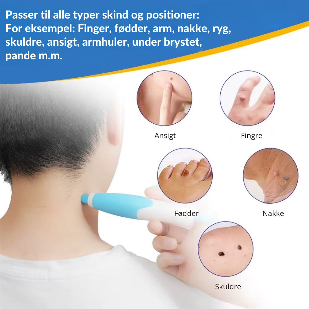 TagErase™ | Sig farvel til stamvorter