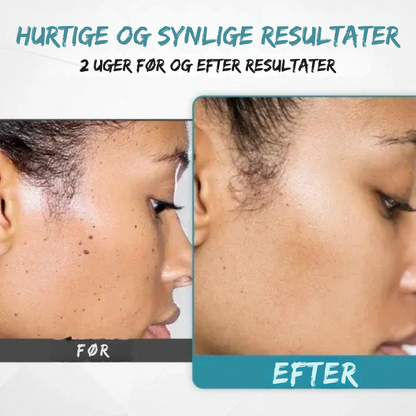 SilkLaser™ | Præcision og blødhed i ét