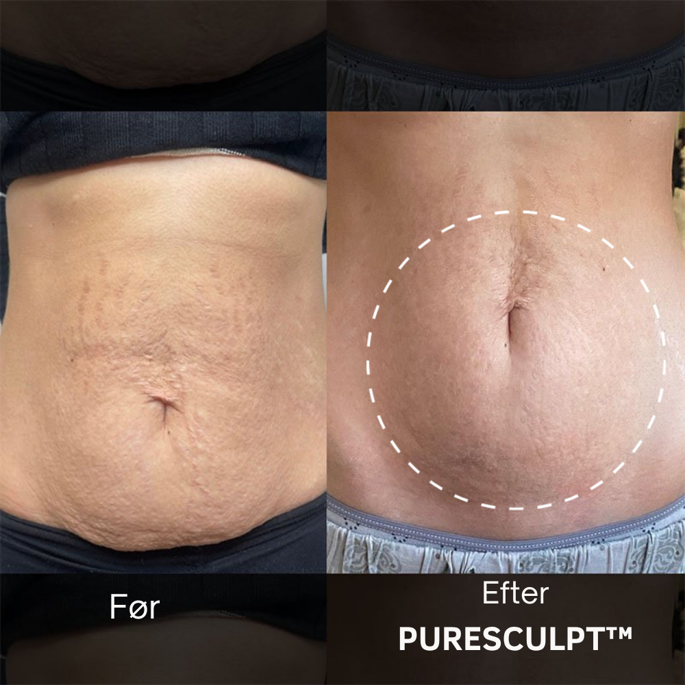 PureSculpt™ | Opstram, udglat og forny din hud – naturligt og effektivt