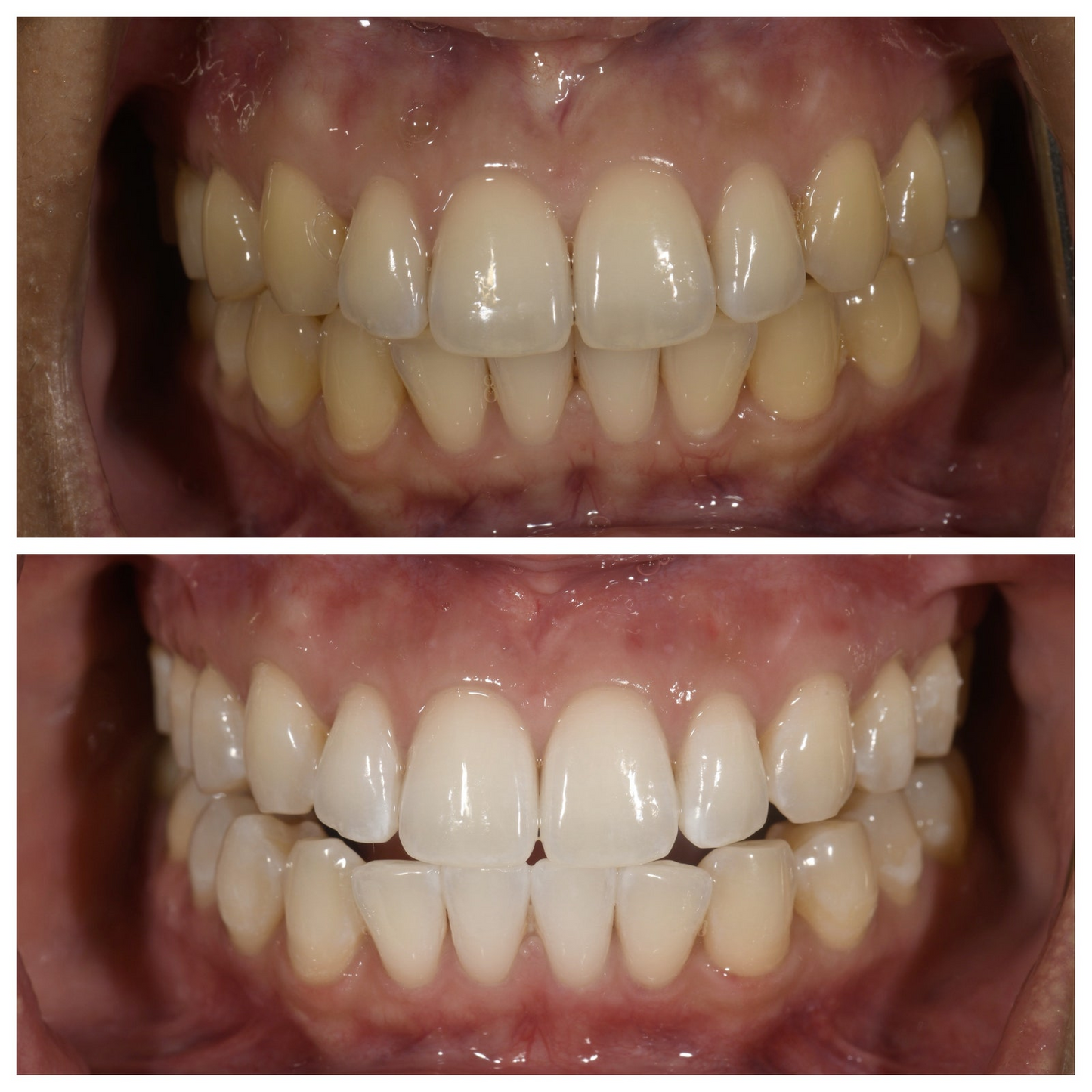 BrightWhite™ | Slip kraften i et lysere smil løs