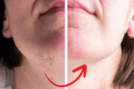 EpiLisse™ | Skånsom hårfjerningscreme til silkeblød hud – uden smerte eller rødme