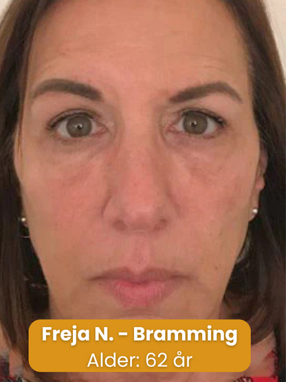 BeeYoung™ | Foryng din hud naturligt – uden nåle eller dyre behandlinger