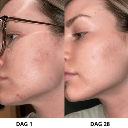 DermaPure™ | Ultralydsskrubber til huden