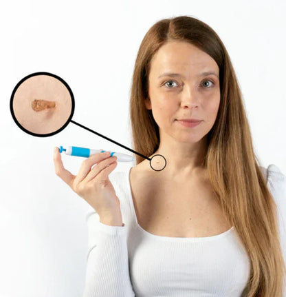 TagErase™ | Sig farvel til stamvorter