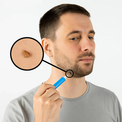 TagErase™ | Sig farvel til stamvorter