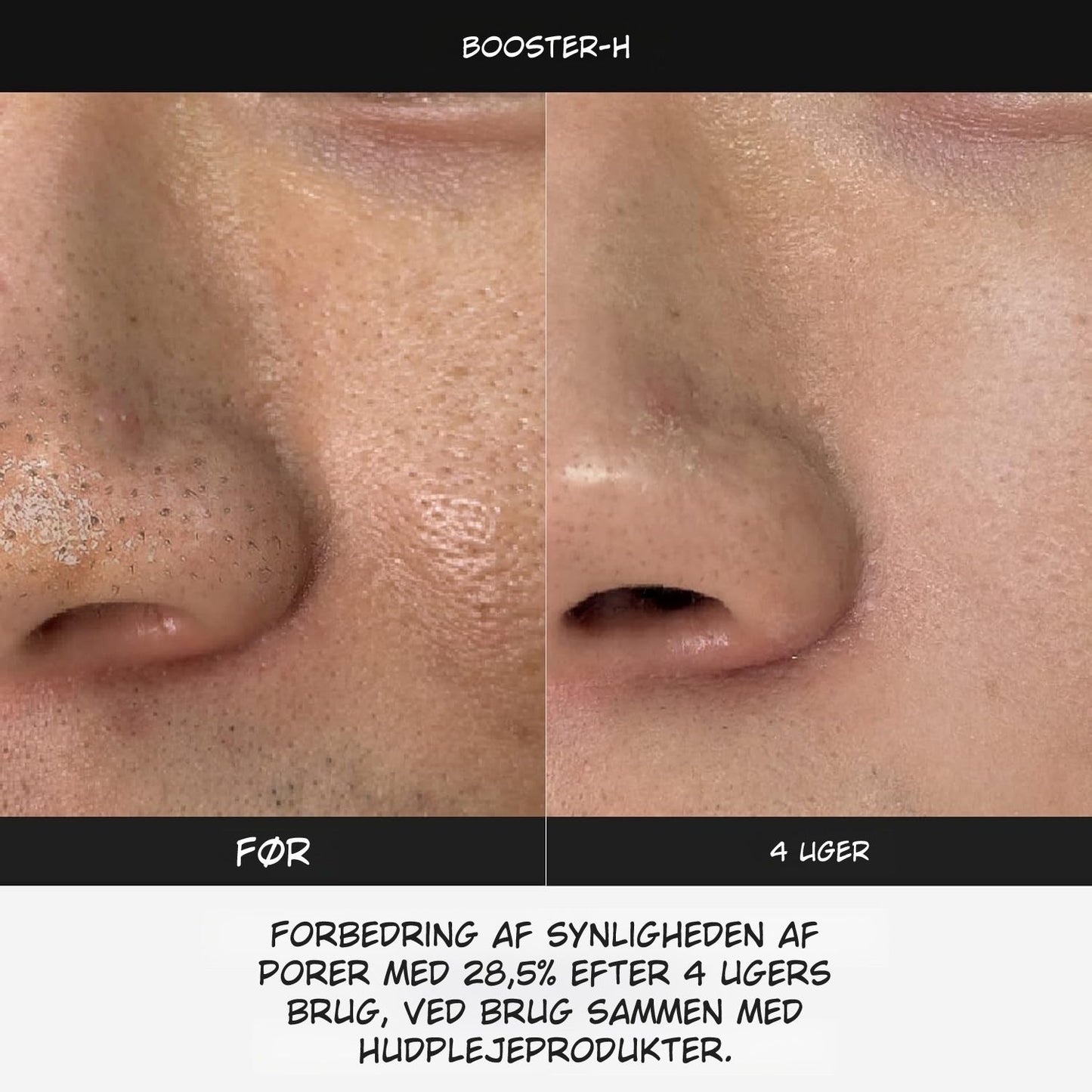 LumaBooster™ | Avanceret Hudpleje til Bedre Hudstruktur og Aknebehandling