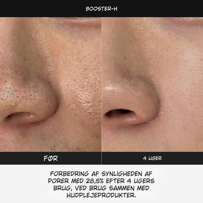 LumaBooster™ | Avanceret Hudpleje til Bedre Hudstruktur og Aknebehandling