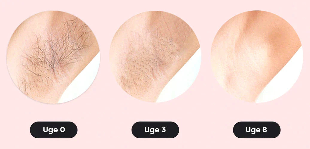 SmoothTouch™ IPL | Permanent hårfjerning – skånsom teknologi til glat hud hele året